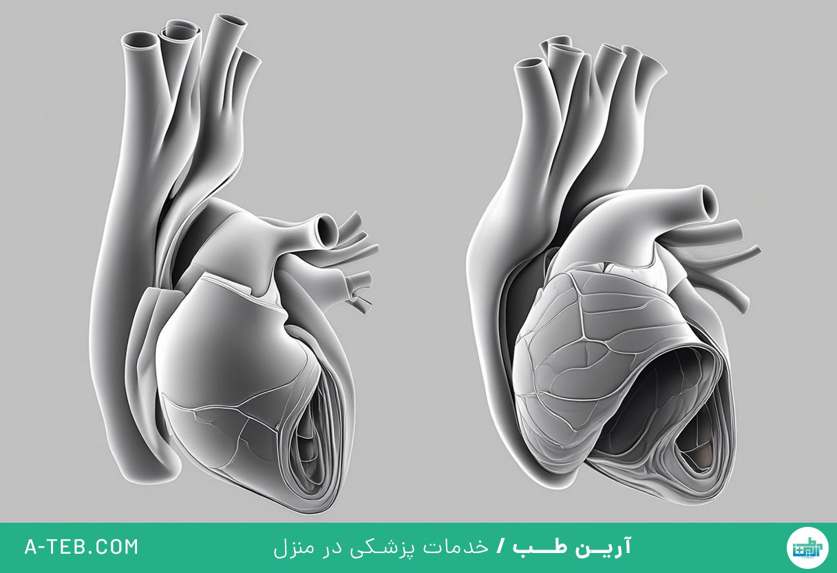 افتادگی دریچه تری کوسپید