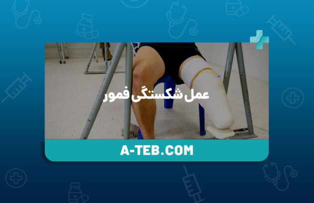 عمل شکستگی فمور