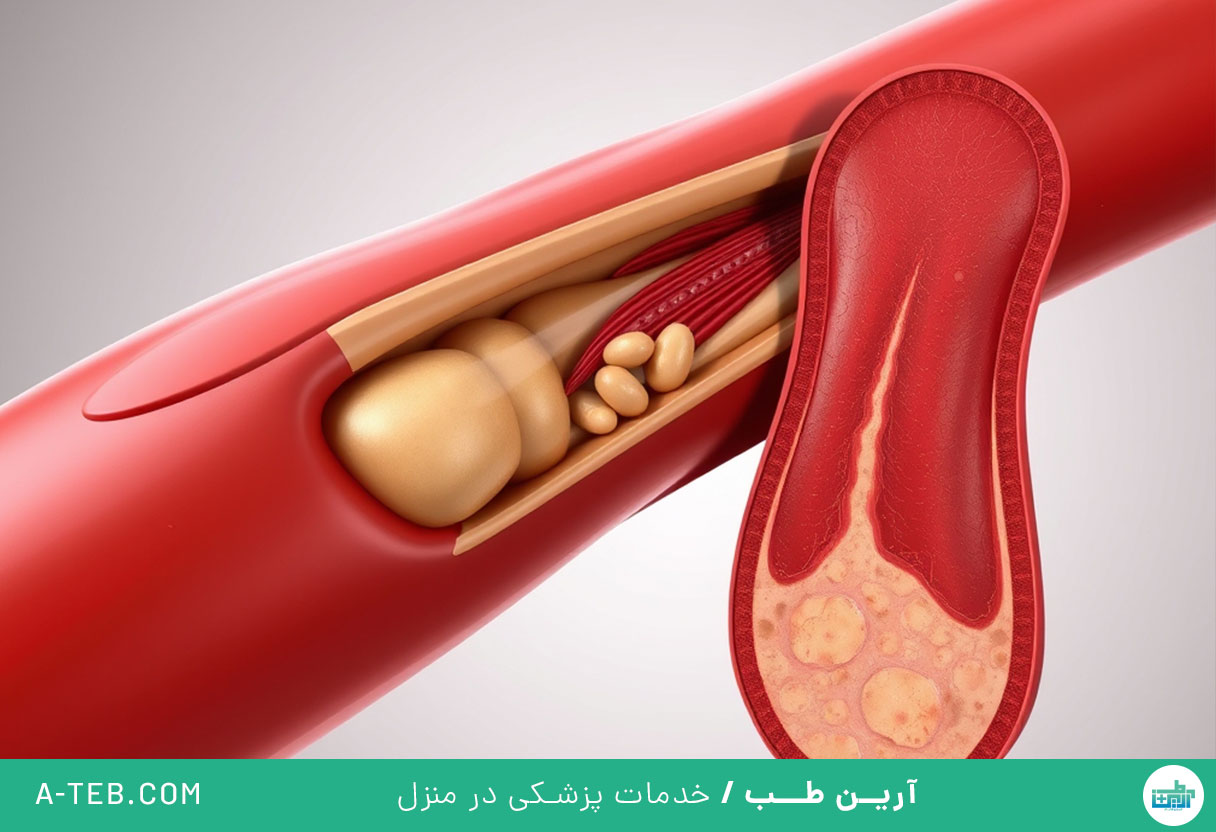 آترواسکلروز