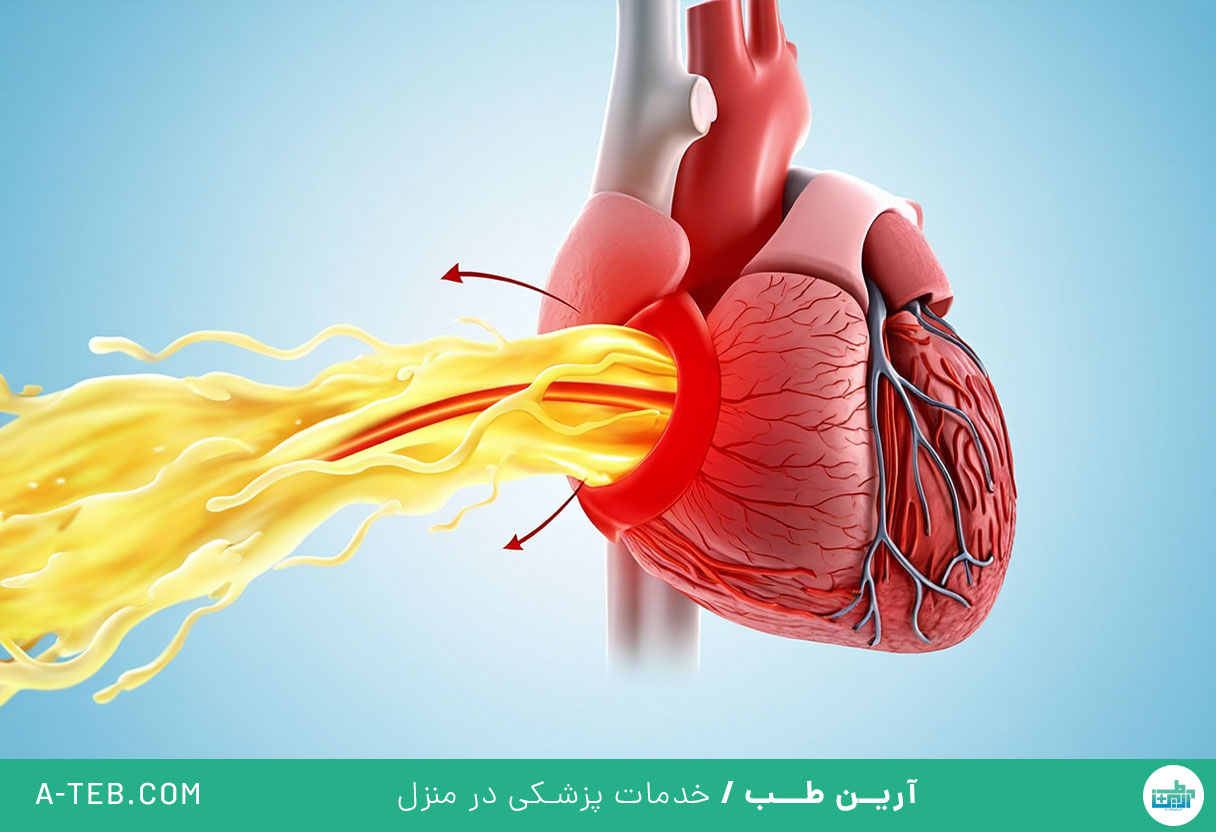 تنگی دریچه تری کوسپید