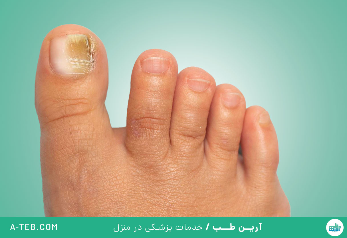 فرو رفتن ناخن در گوشت پا
