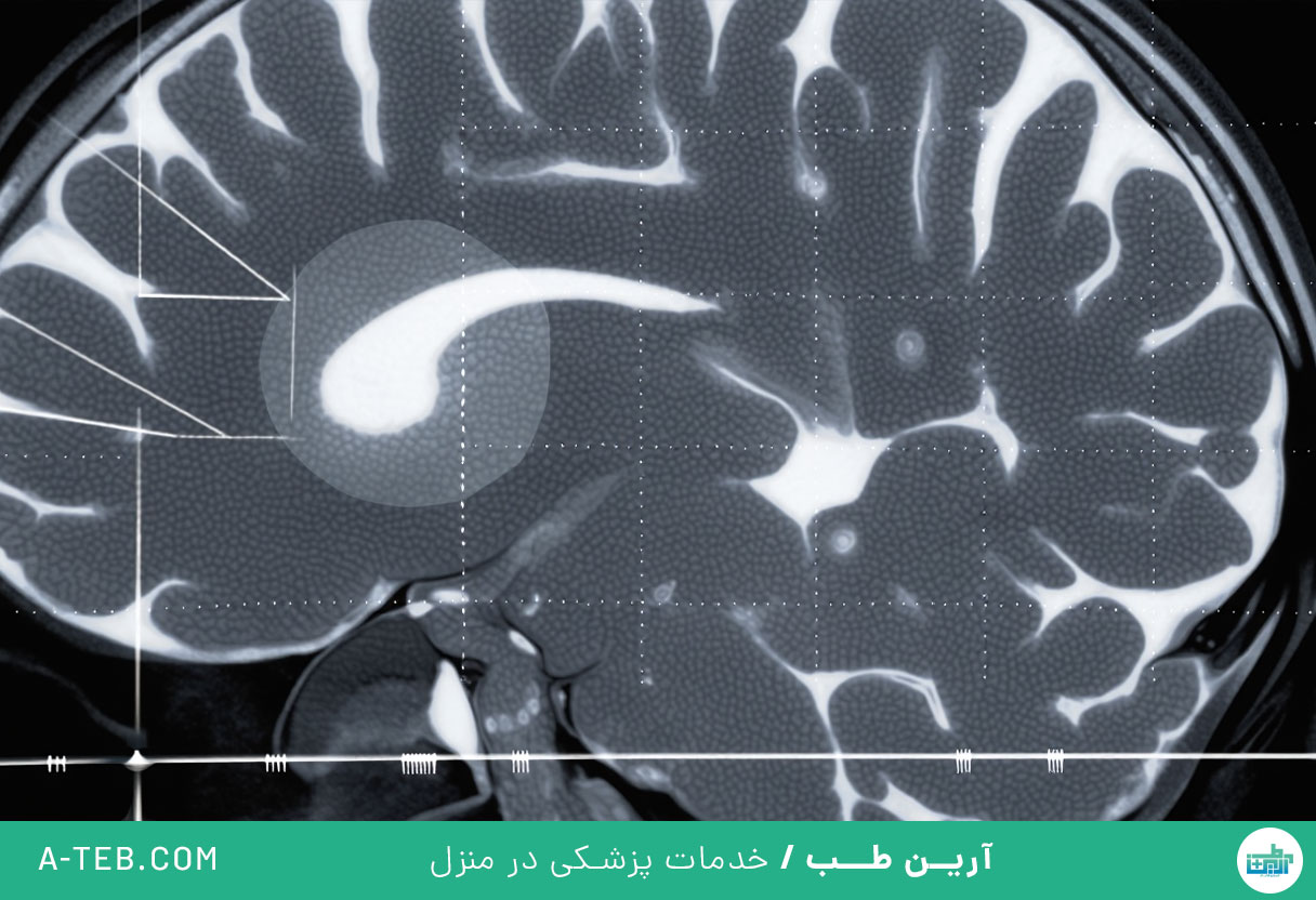 سکته مغزی خفیف