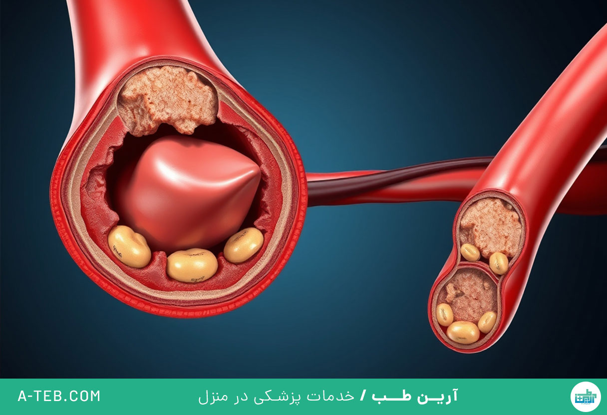 آترواسکلروز
