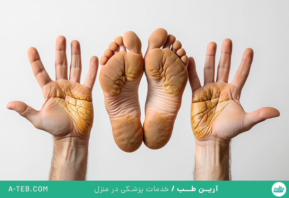 کراتودرما