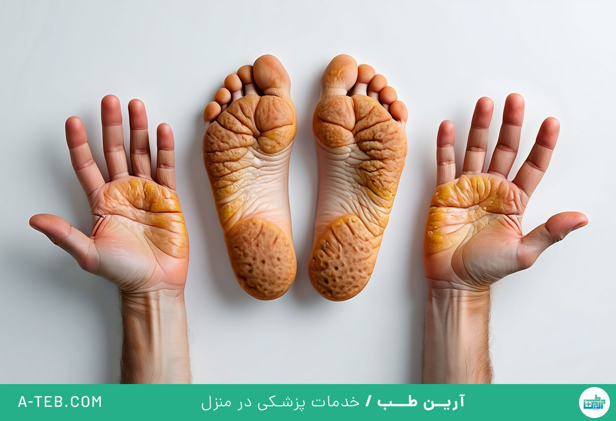 کراتودرما