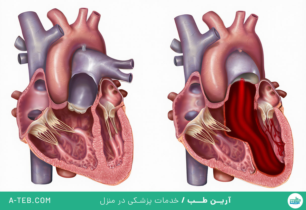 بیماری دریچه ریوی