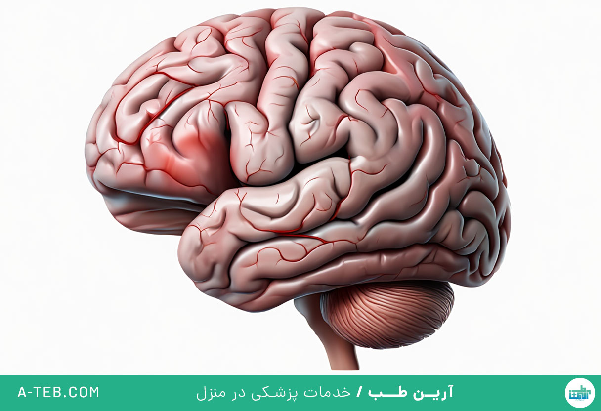 سکته مغزی خفیف