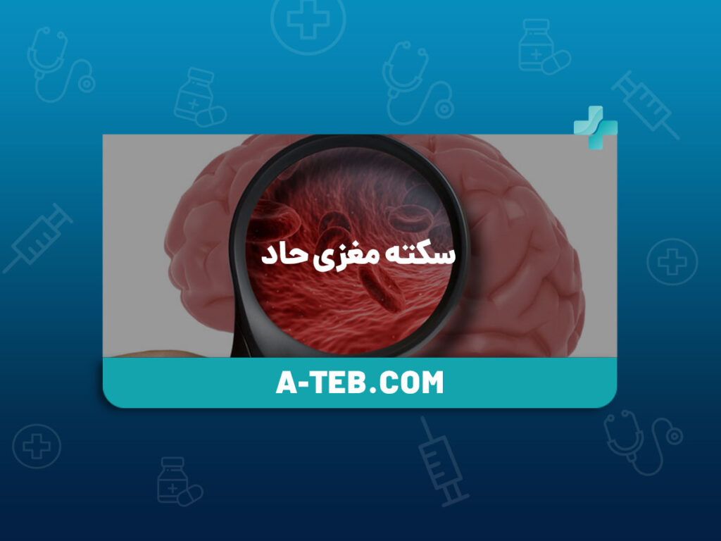 سکته مغزی حاد