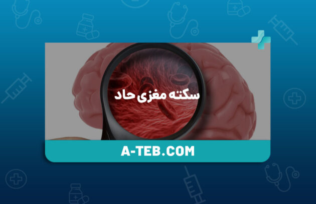 سکته مغزی حاد