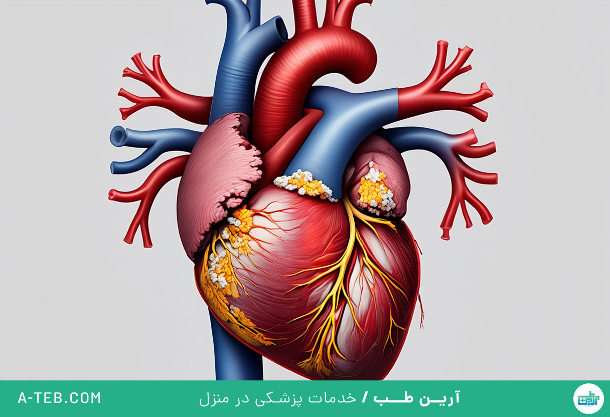 کلسیفیکاسیون عروق کرونر