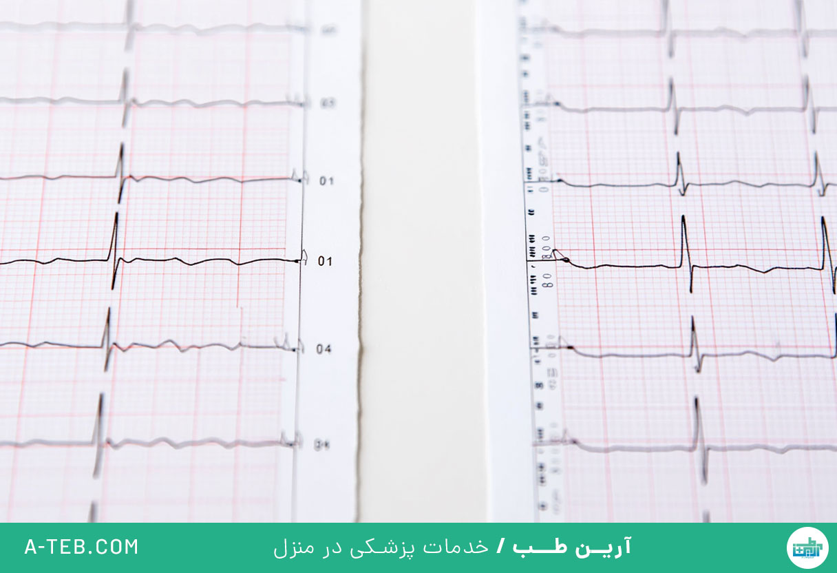 سندرم QT طولانی