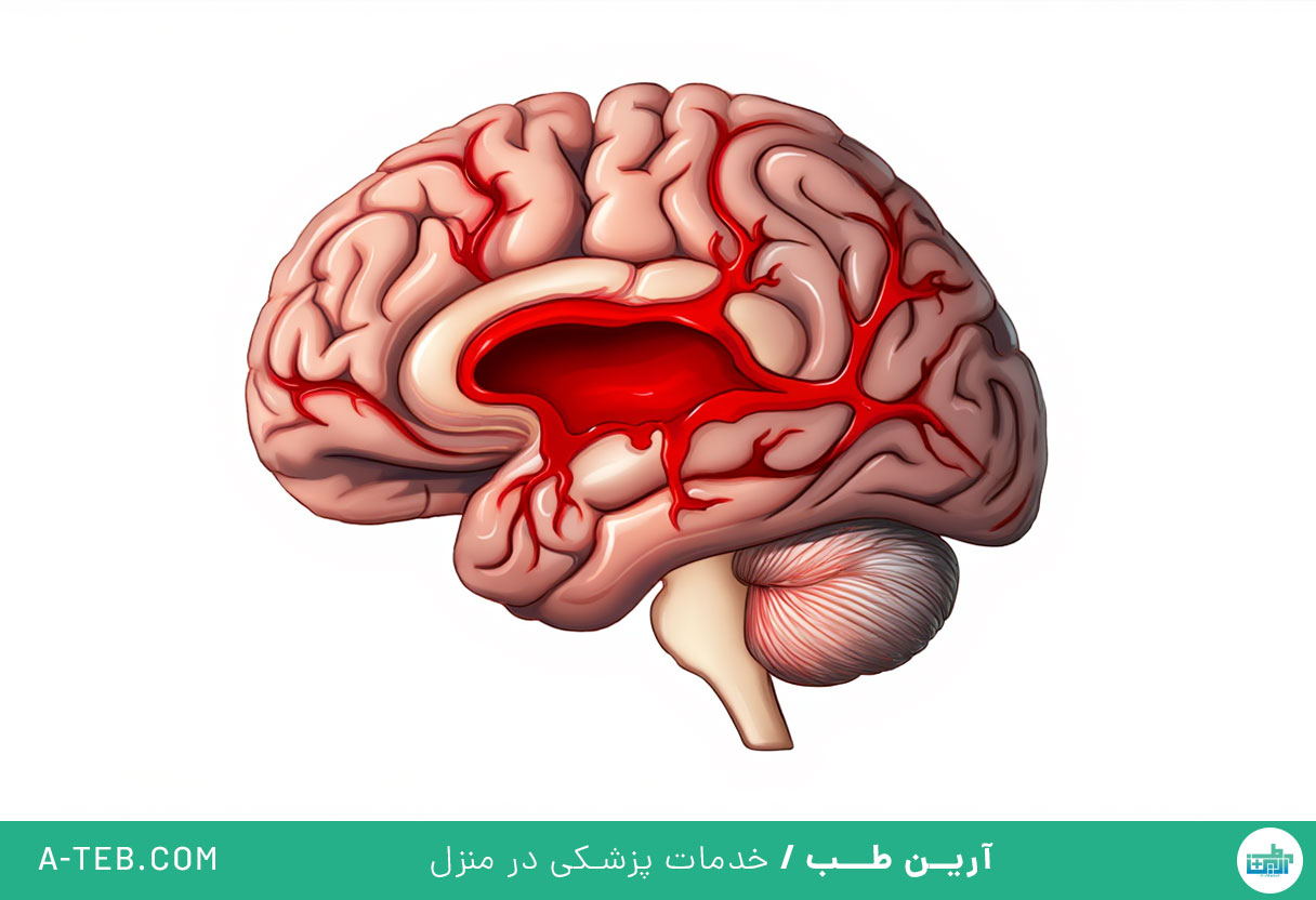 سکته مغزی هموراژیک