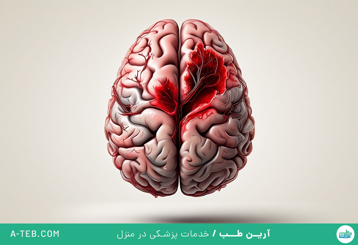 خونریزی مغزی به علت فشار خون بالا