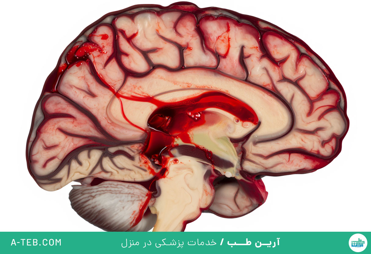 خونریزی مغزی ناشی از ضربه