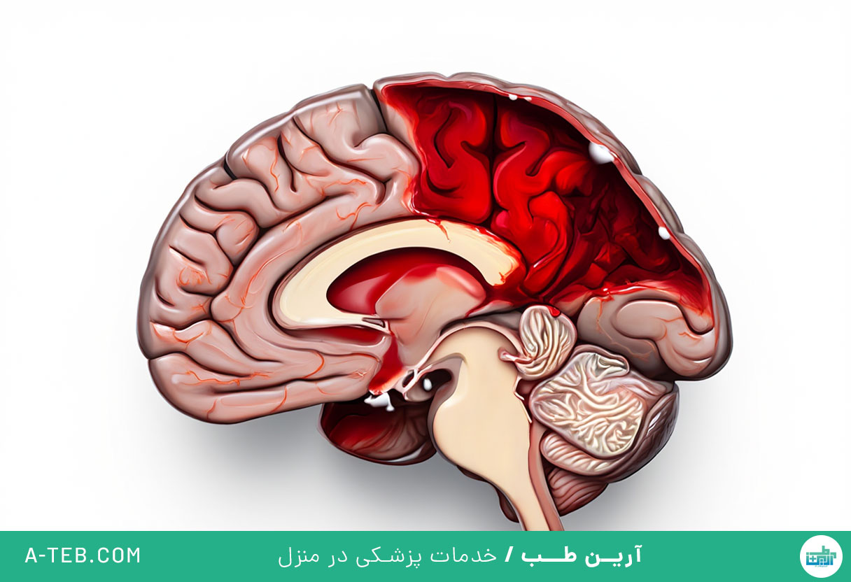 خونریزی مغزی ناشی از ضربه