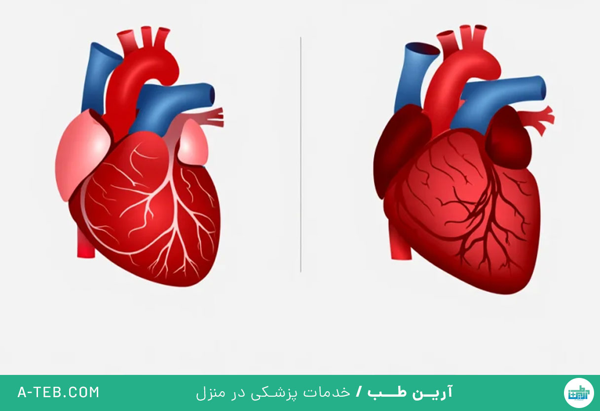 بیماری قلبی ناشی از چاقی