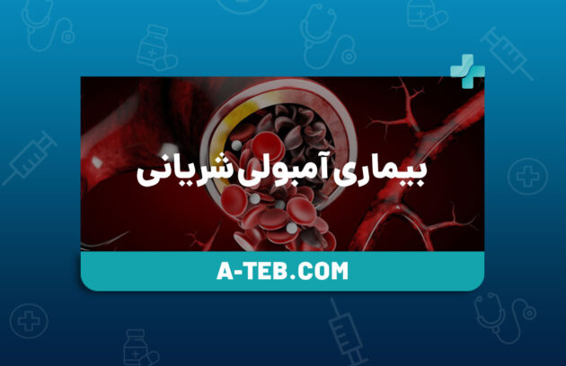 بیماری آمبولی شریانی