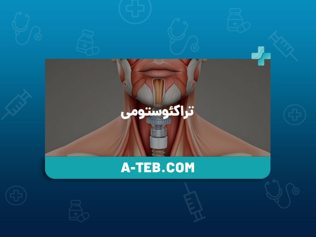 تراکئوستومی