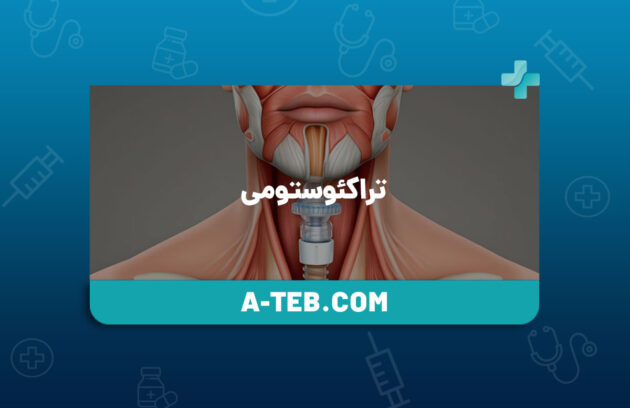تراکئوستومی