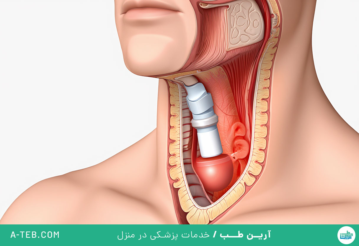 تراکئوستومی