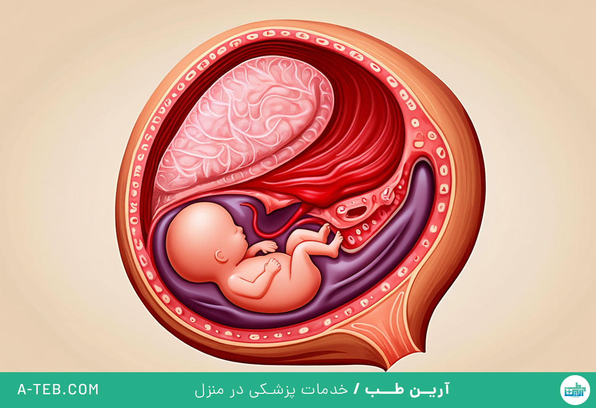 هماتوم در بارداری