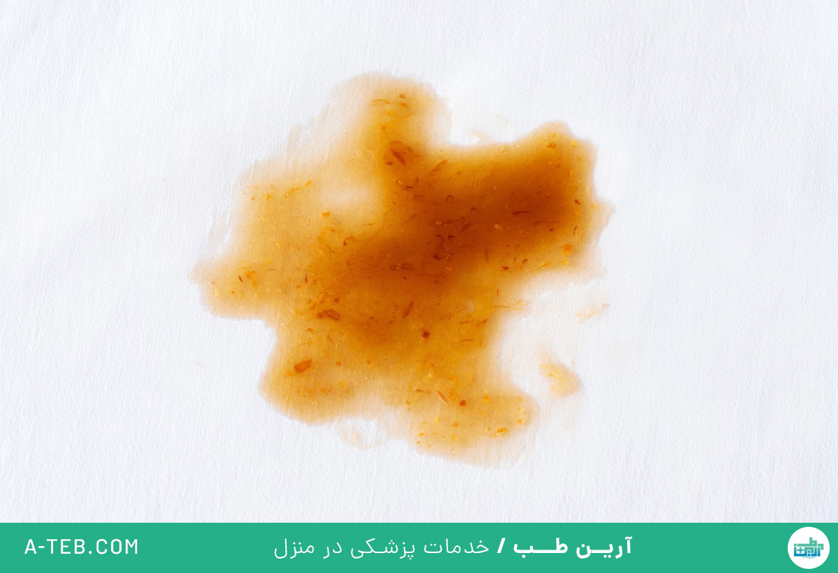 ترشحات قهوهای واژن