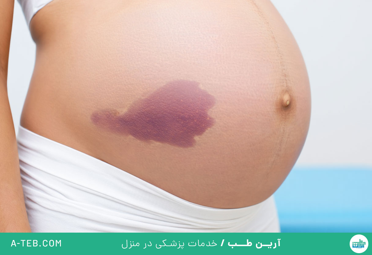 هماتوم در بارداری