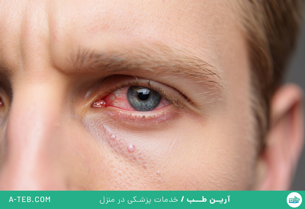 عفونت چشم در سرماخوردگی