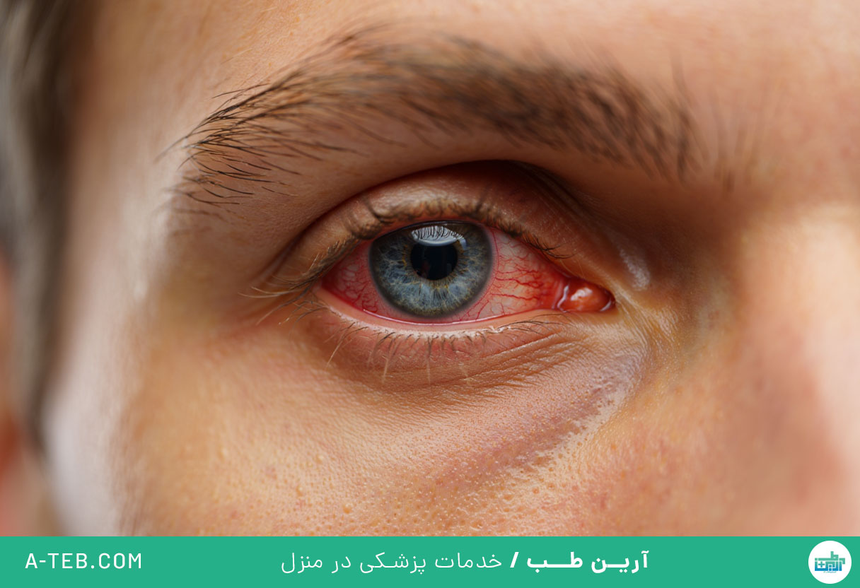 عفونت چشم در سرماخوردگی