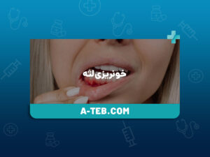 خونریزی لثه