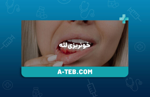 خونریزی لثه