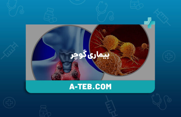 بیماری گوچر