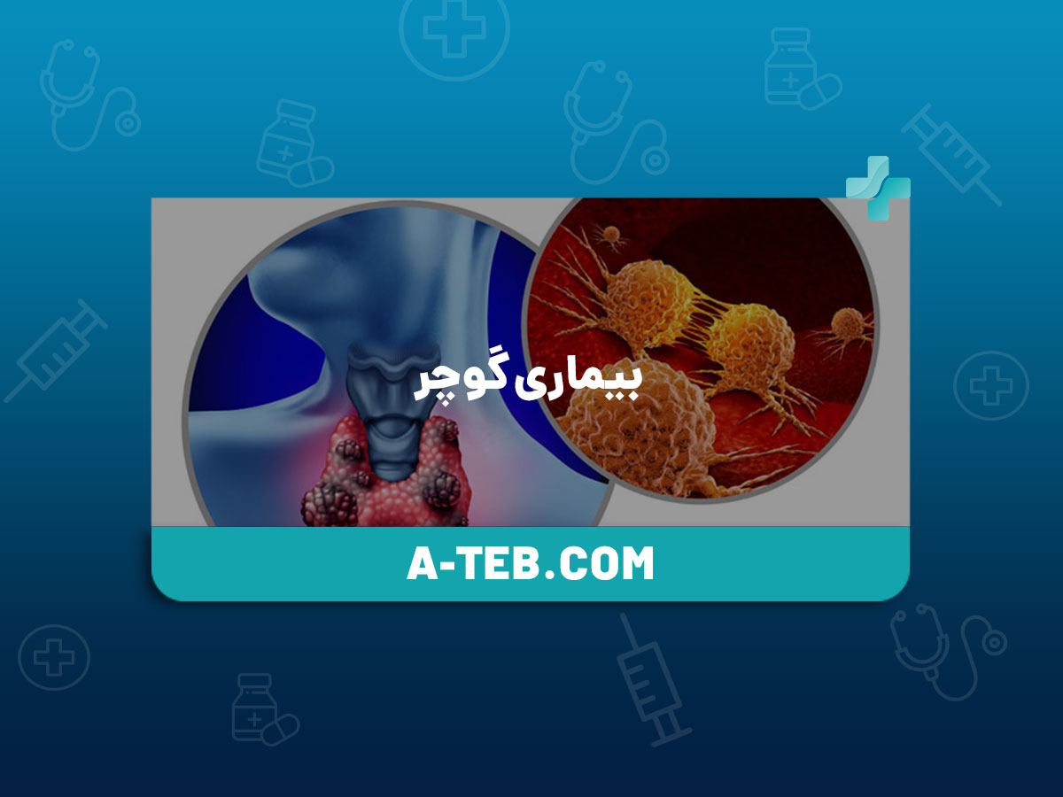 بیماری گوچر