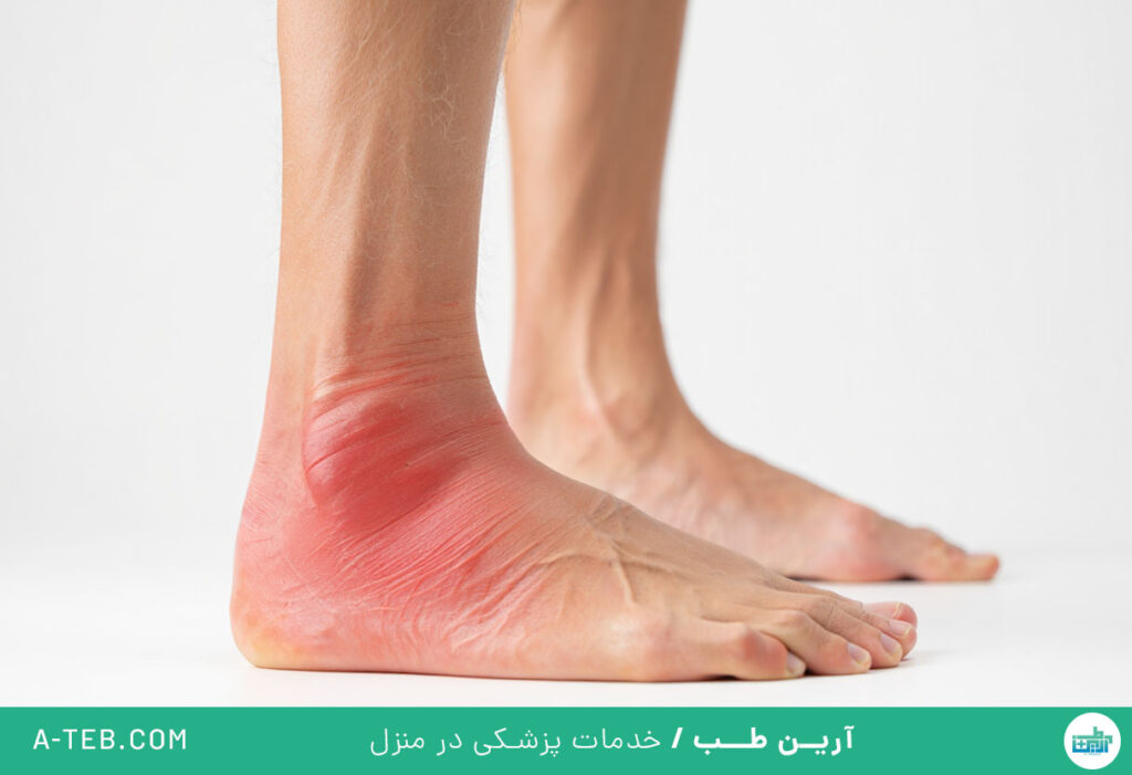 ورم ساق پا