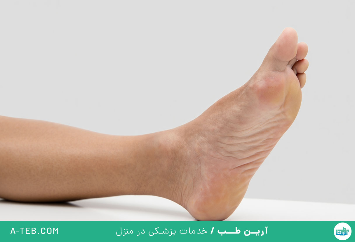 ورم ساق پا
