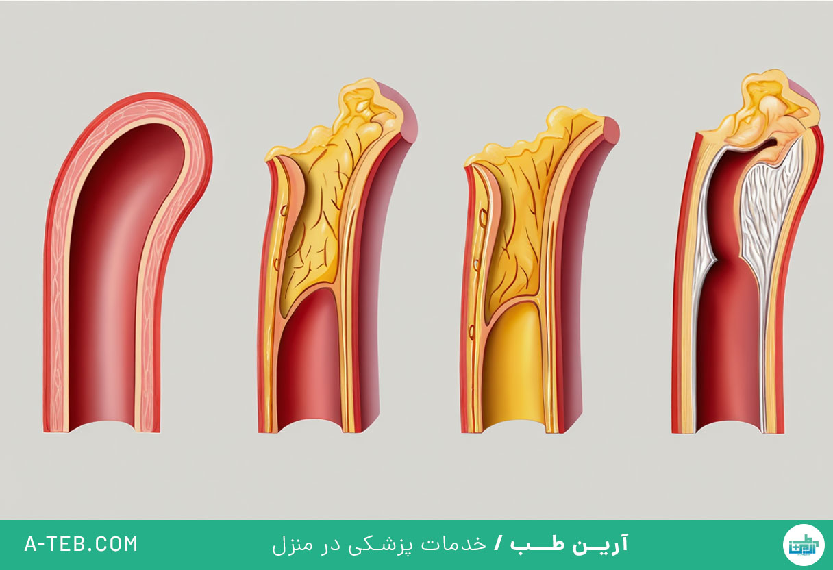 آترواسکلروز