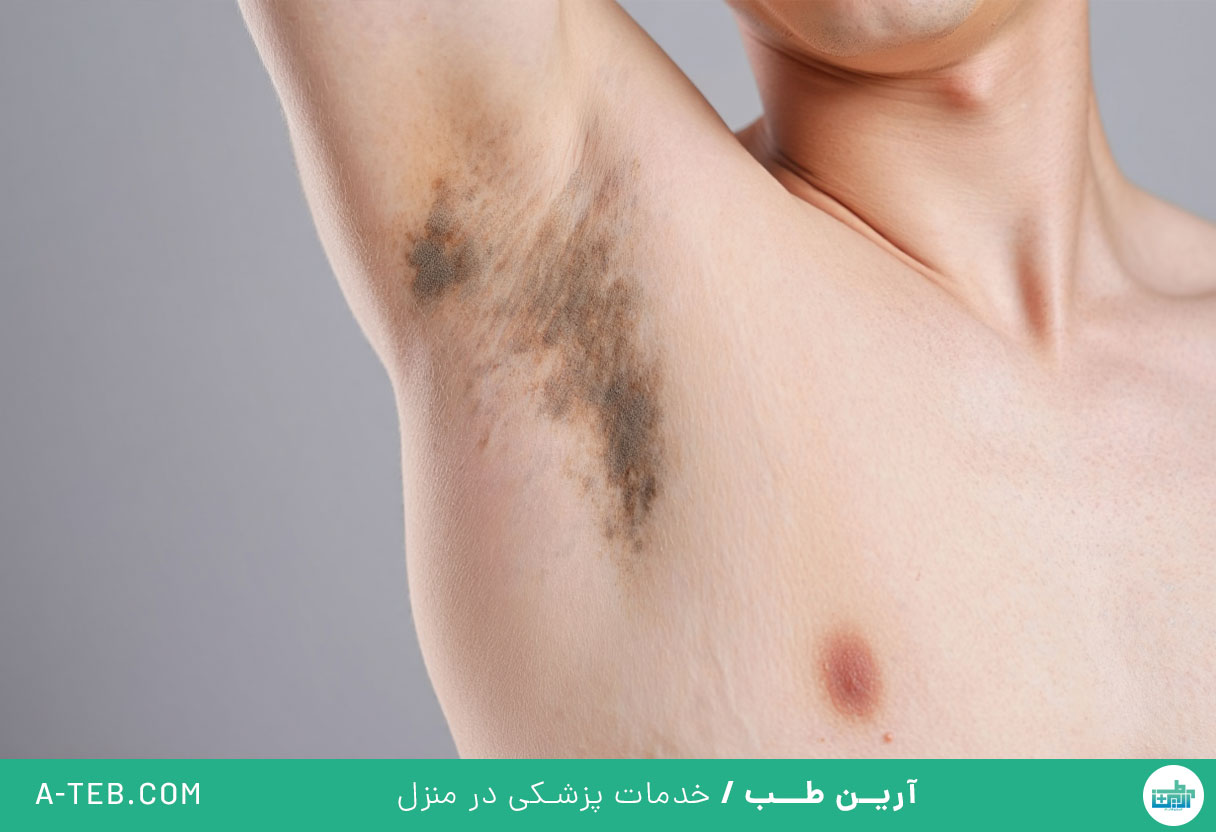 سیاهی زیر بغل