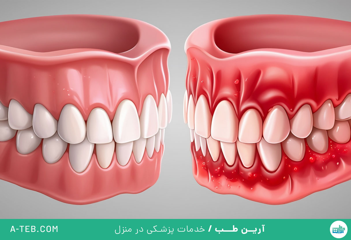 التهاب لثه