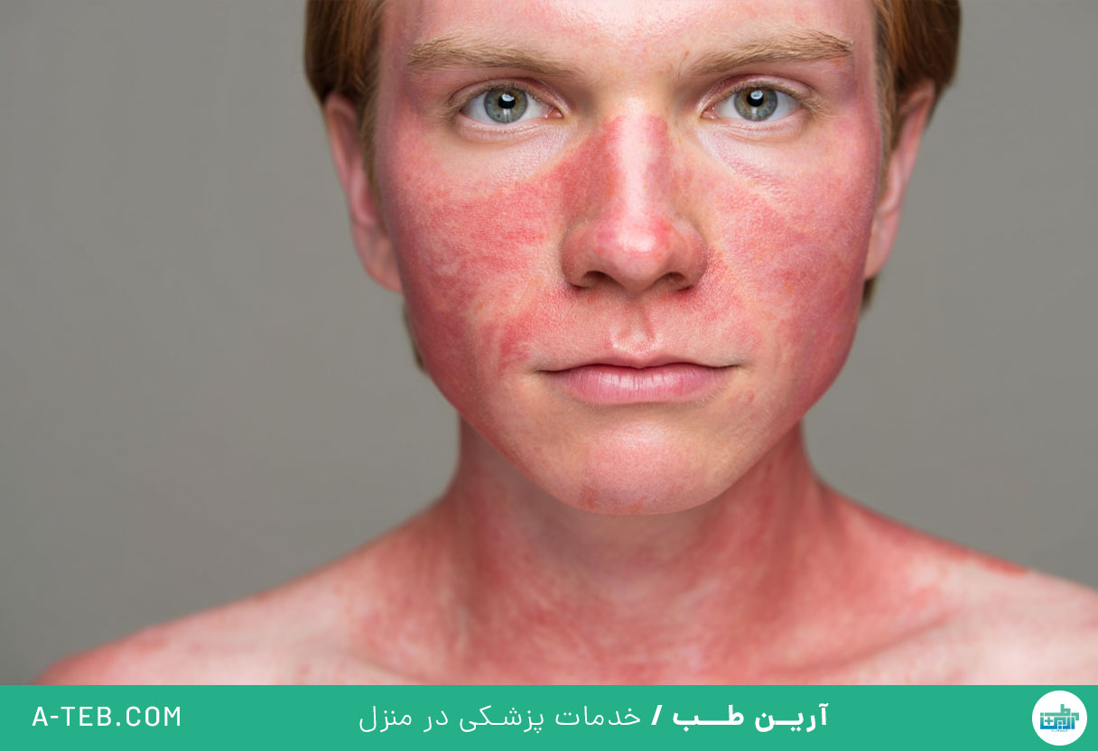 آفتاب سوختگی