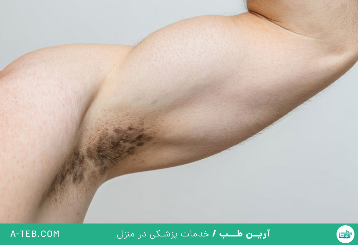 سیاهی زیر بغل