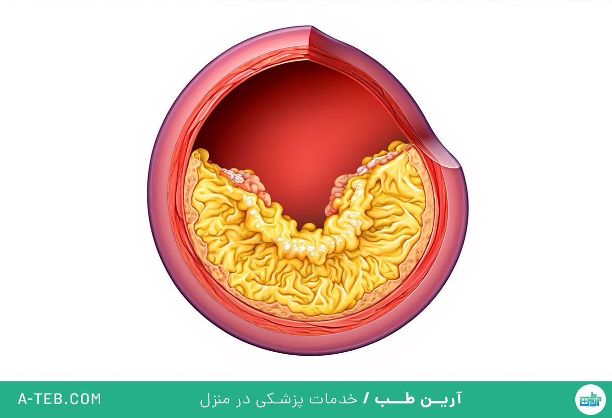 تنگی شریان ها