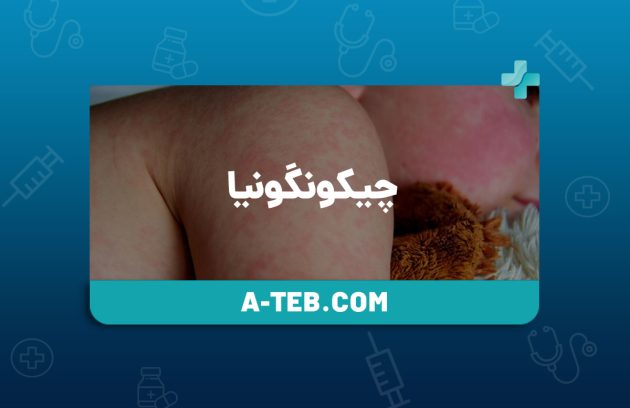 چیکونگونیا