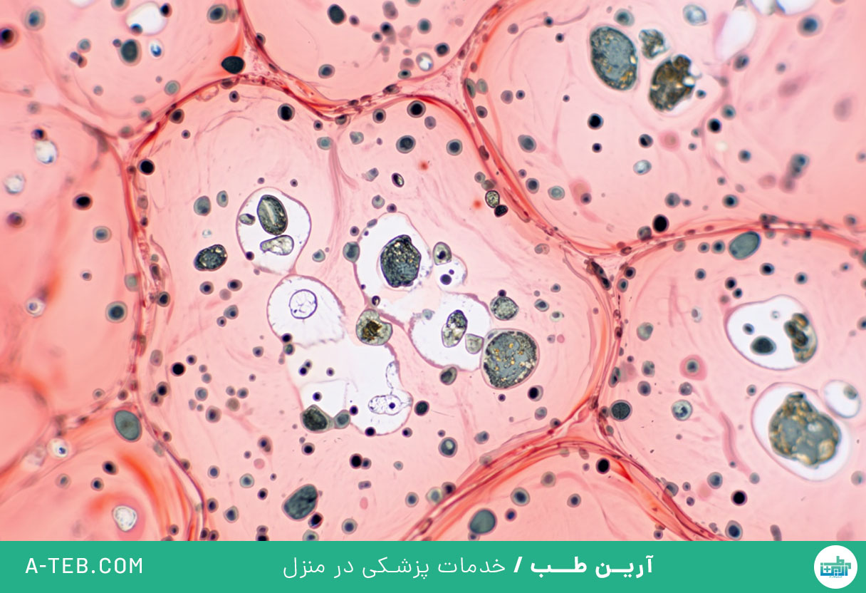 پنوموکونیوز