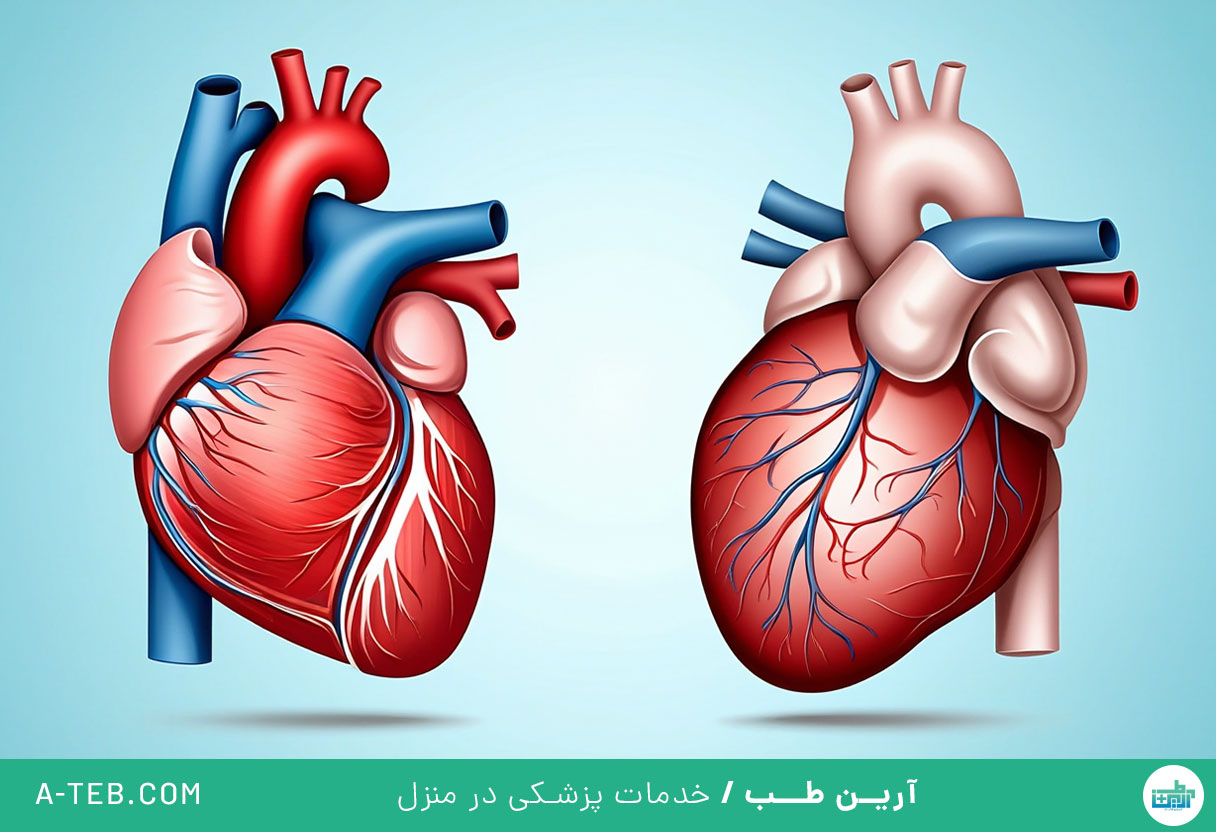 کاردیومیوپاتی دیلاته