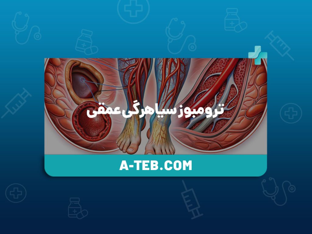 ترومبوز سیاهرگی عمقی
