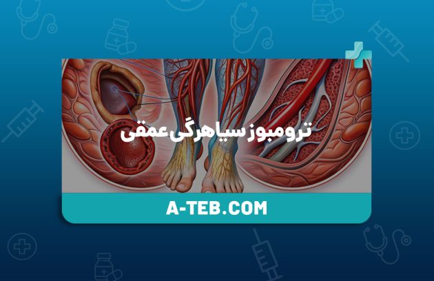 ترومبوز سیاهرگی عمقی