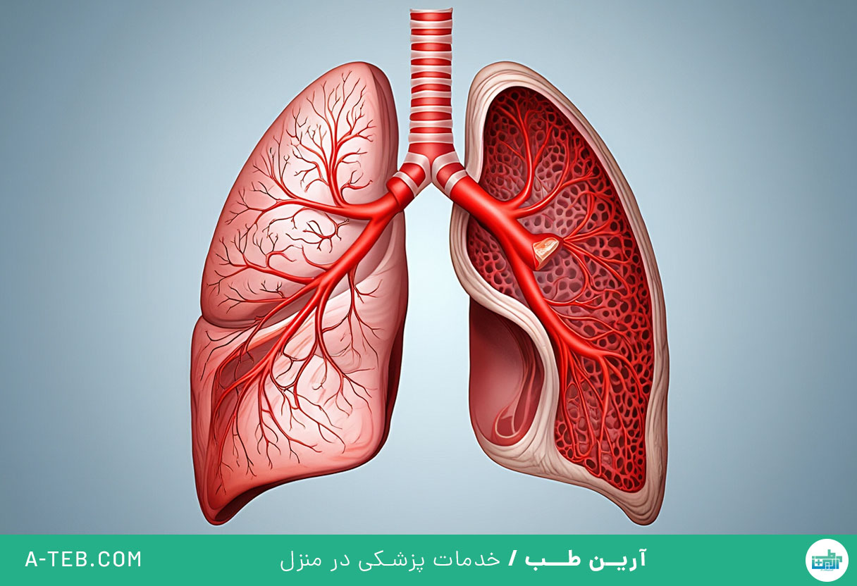 هیپرتانسیون ریوی