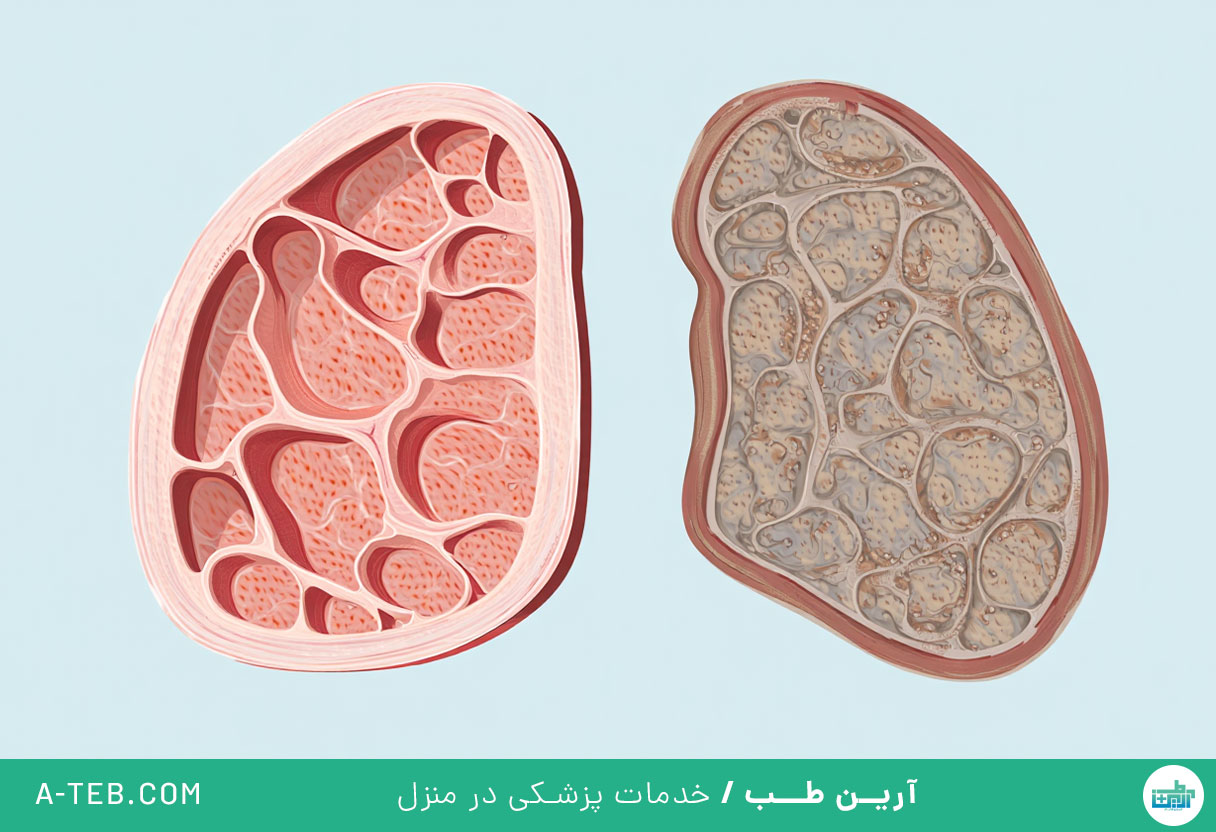 بیماری بینابینی ریه