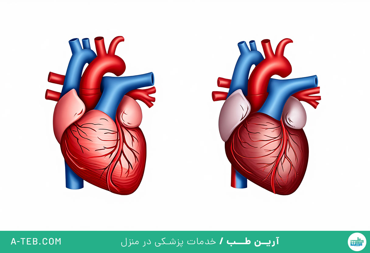 کاردیومیوپاتی محدود کننده