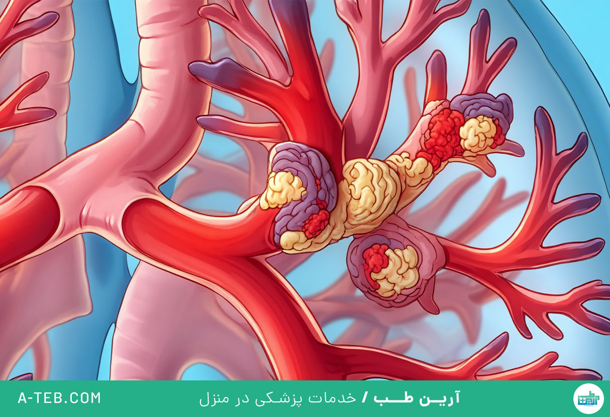آلرژی تنفسی
